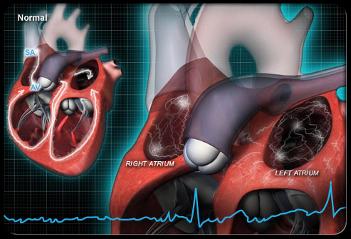 atrial-fibrillation-s3-photo-of-heart-rhythm.jpg